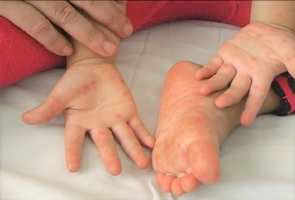 Trường học tăng cường phòng chống dịch tay - chân - miệng